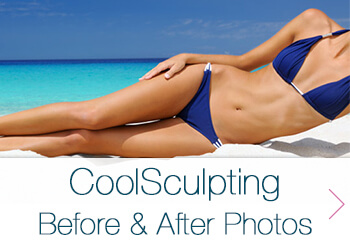 CoolSculpting Before and After Photos Graphic Featuring Woman Wearing a blue bikini on the beach