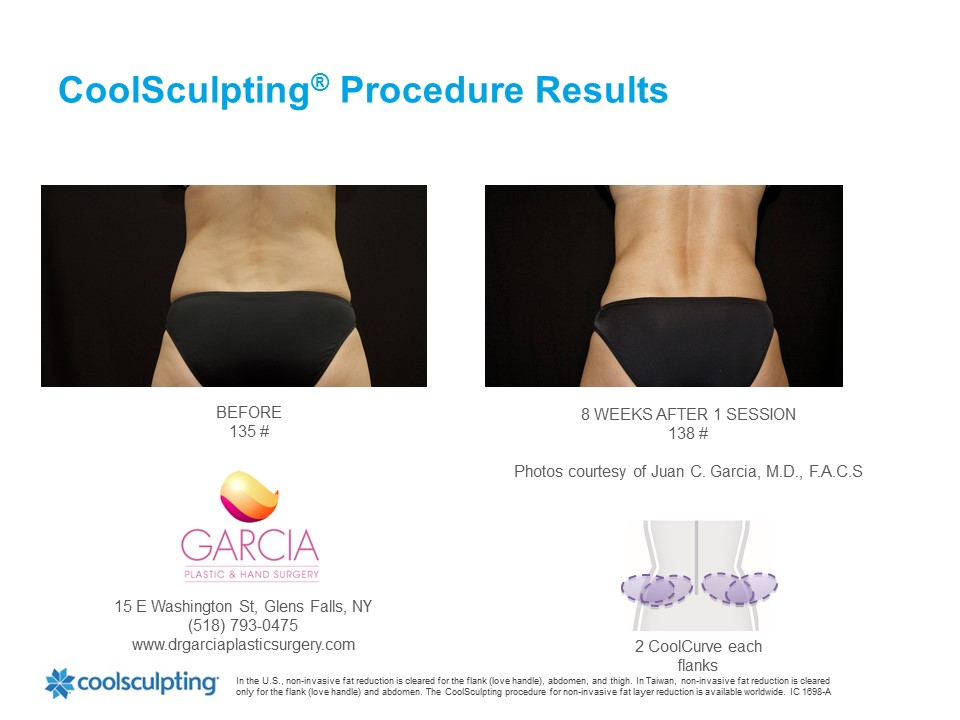 CoolSculpting Before and After Picture of Female Lower Abdomen