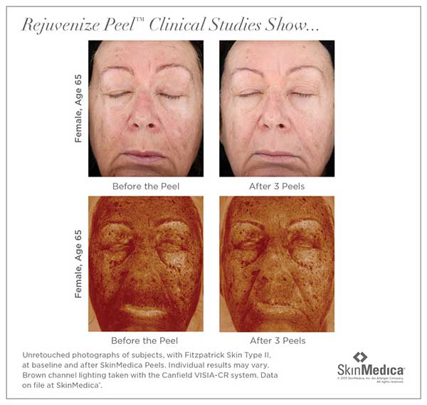 before and after photos for Rejuvenize facial chemical peel