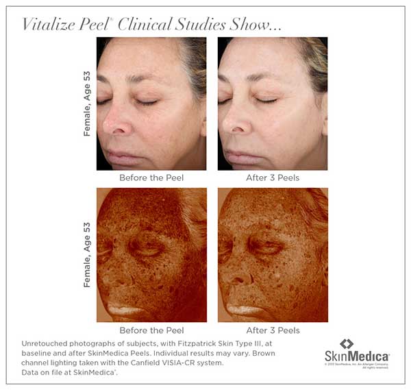 before and after photos for Vitalize facial chemical peel