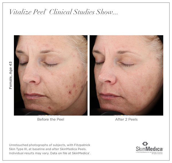 before and after photos for Vitalize facial chemical peel