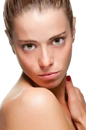 How to Reduce Acne Scarring