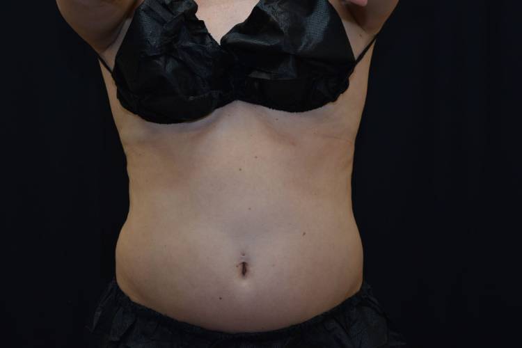 Front view of CoolSculpting patient before the treatment - view of Abdomen from the front