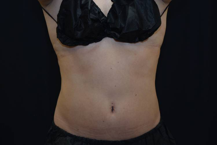 Front view of CoolSculpting patient after abdomen and lovehandle treatments