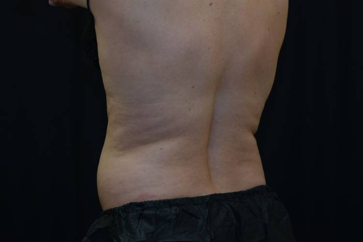 Back side view of a CoolSculpting patient before treatment - Before photo