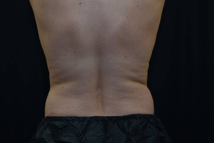 Lower back view of a CoolSculpting patient before treatment - Before Photo