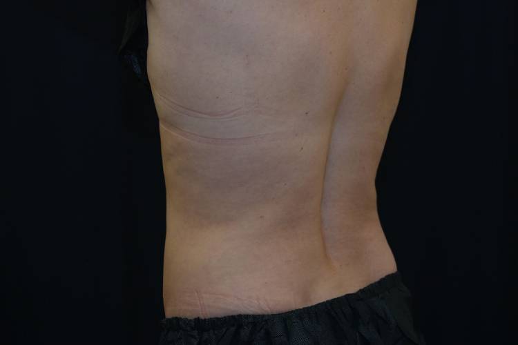 Left and back side view of CoolSculpting patient after treatments