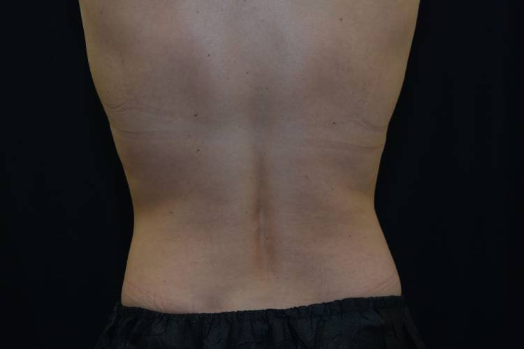 Lower Back view of patient after two rounds of CoolSculpting treatment
