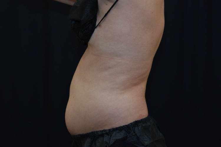Left side view of a patient's lovehandles before CoolSculpting treatment