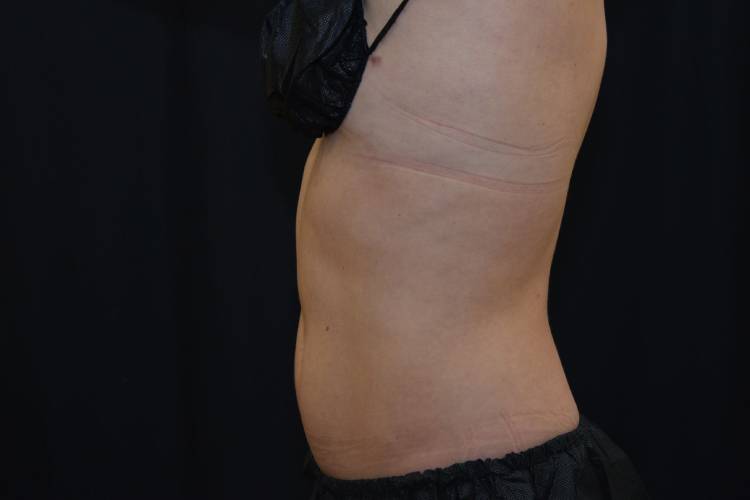 Left side view of lovehandles after CoolSculpting treatment