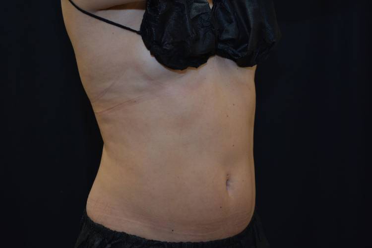 Front right side view of lovehandles and abdomen after two rounds of CoolSculpting treatment