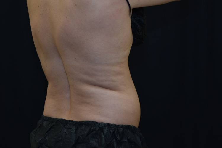 Right hand side view of the back and lovehandle of a CoolSculpting patient before treatment