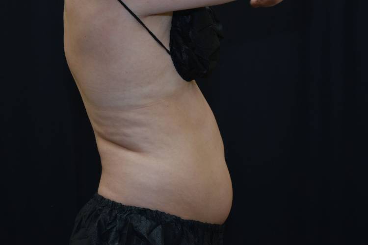 Right side view of a CoolSculpting patient before treatment on the right hand side of lovehandles