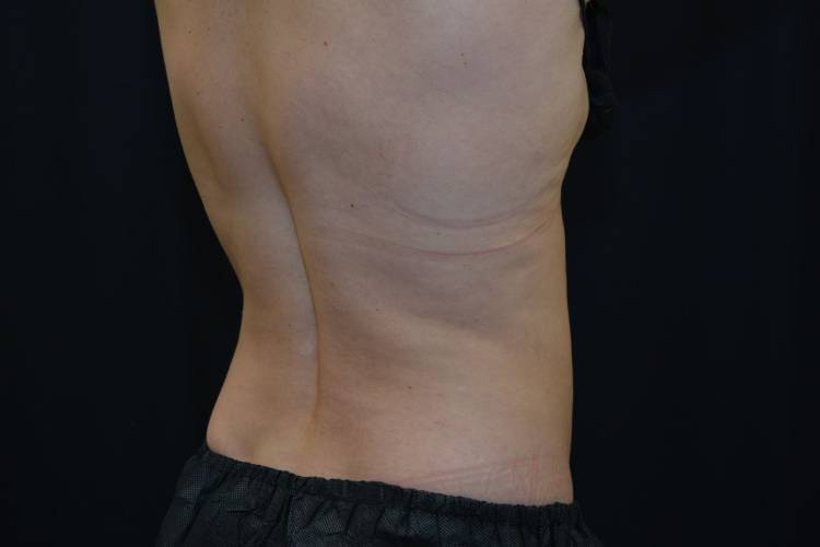 Right side lower back and lovehandle of a patient after CoolSculpting treatment - After Photo
