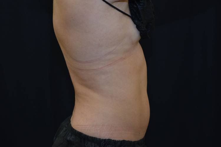 Right side view of lovehandles of a CoolSculpting patient after the treatments 