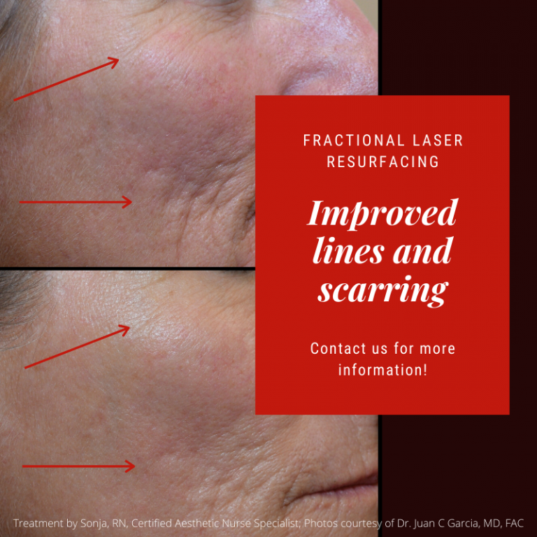 Improved Lines and Scarring