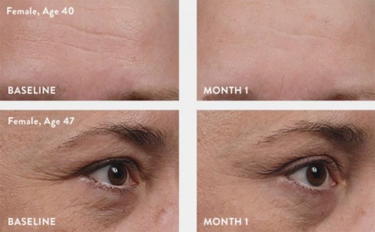Before and after photos of a patient using TNS Essential Serum